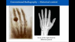 What to Expect During Radiation Treatment  Winship Cancer Institute [upl. by Lyckman]