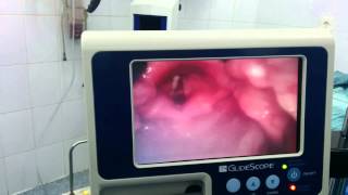 Intubation using the Glidescope Video Laryngoscope [upl. by Euqilegna]