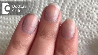 What causes bluish discoloration of nail beds  Dr Rashmi Ravindra [upl. by Perkin334]