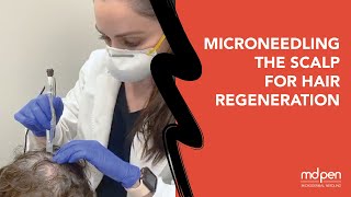 MicroNeedling the Scalp for Hair Regeneration [upl. by Sik]