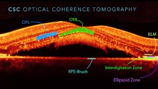 Central Serous Chorioretinopathy Part 2 [upl. by Olegnaid63]