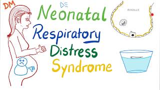 Neonatal Respiratory Distress Syndrome NRDS  Pediatrics  Pulmonology [upl. by Avah]