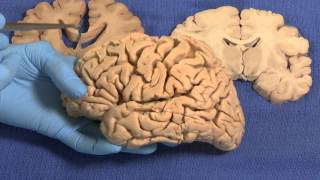 Limbic Neuroanatomy Video Lab  Brain Dissections [upl. by Adena398]