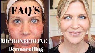 Microneedling  Dermarolling QampA  Before During and After Pics [upl. by Nevah]